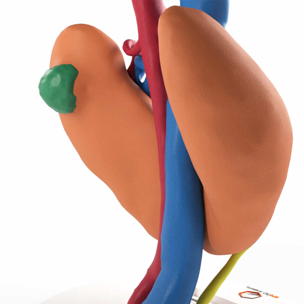 Horseshoe Kidney With Renal Cell Carcinoma (RCC) – Male, 41 Years