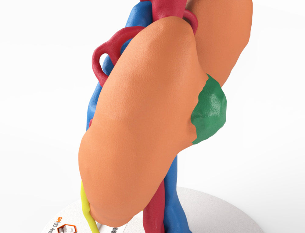 Horseshoe Kidney With Renal Cell Carcinoma (RCC) – Male, 41 Years