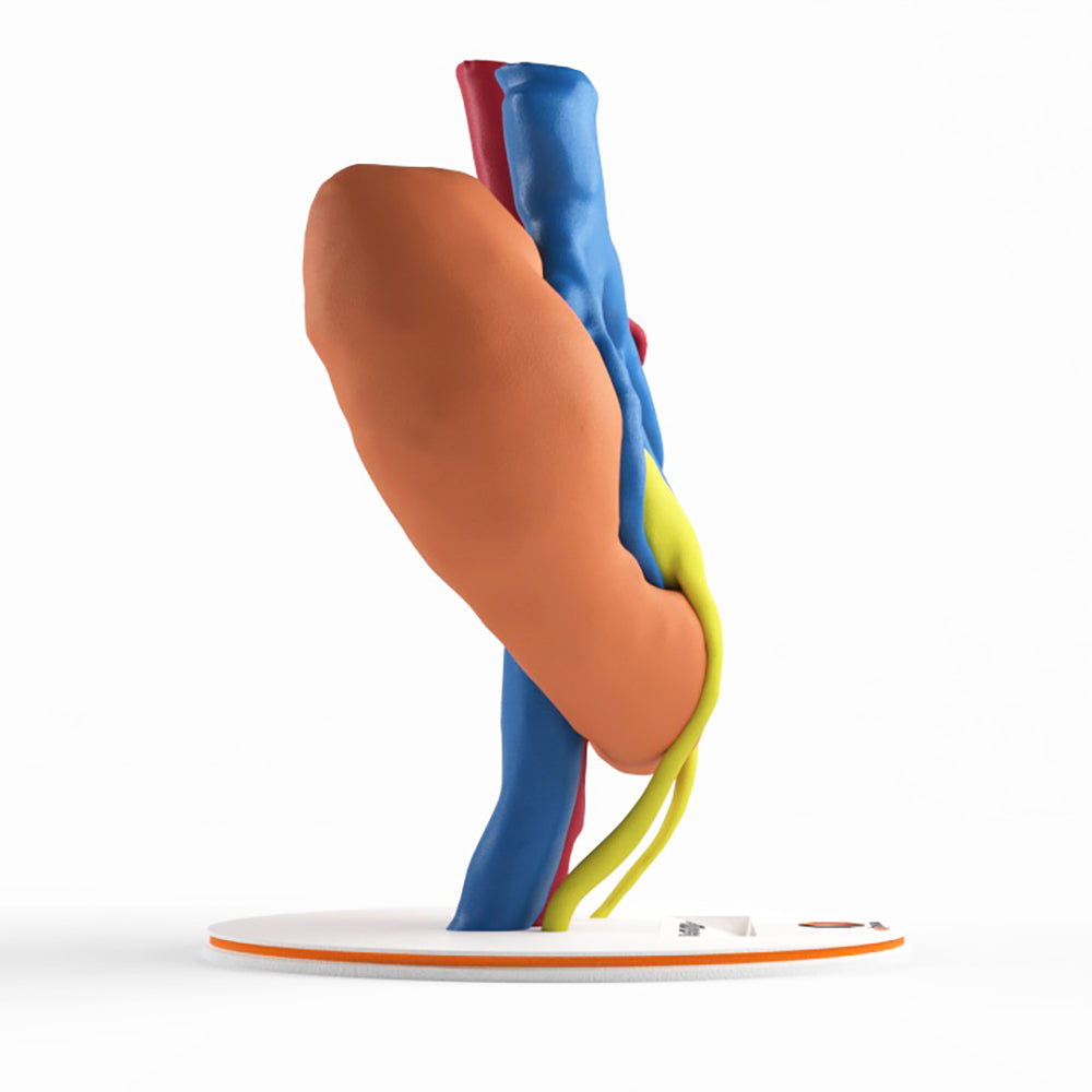 Horseshoe Kidney With Renal Cell Carcinoma (RCC) – Male, 41 Years