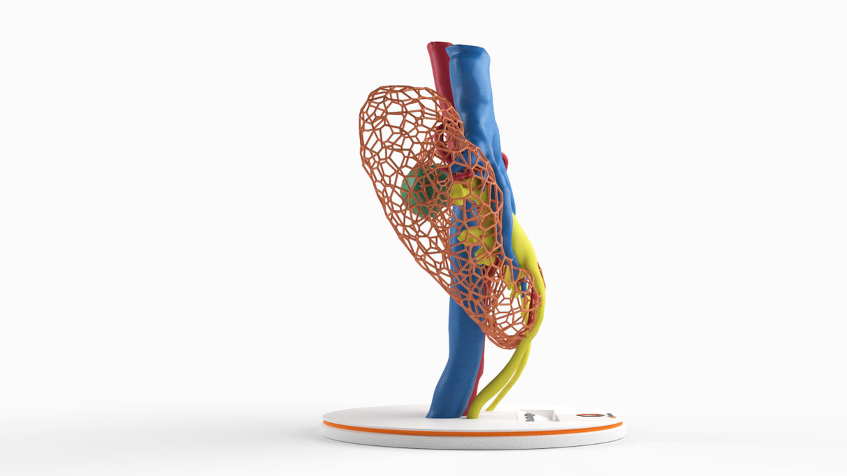 Lattice Horseshoe Kidney With Renal Cell Carcinoma (RCC) – Male, 41 Years