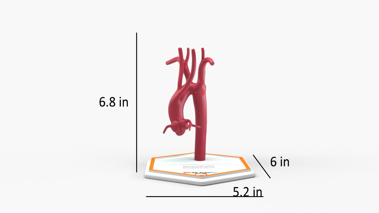 Kommerell's Diverticulum (Connected)