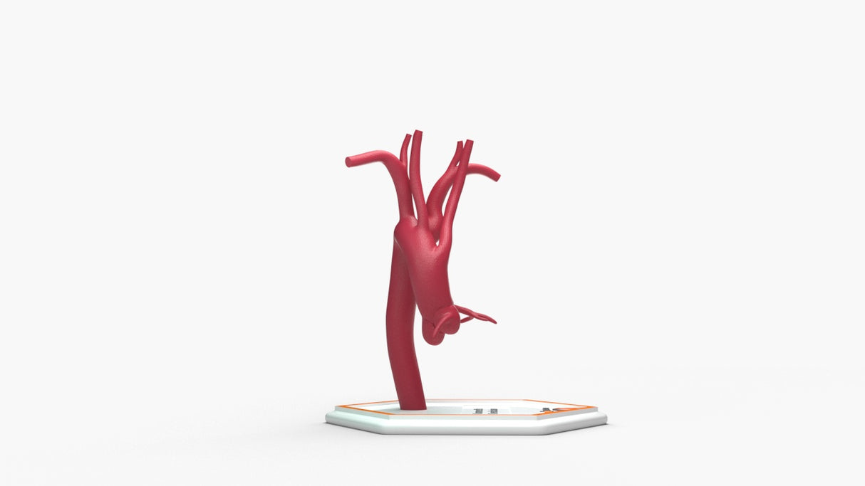 Kommerell's Diverticulum (Connected)