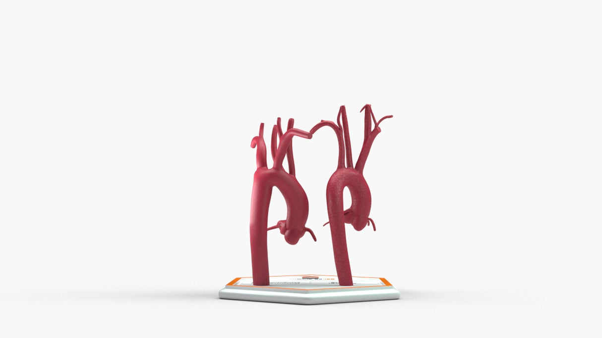 Normal & Kommerell's Diverticulum (Connected)