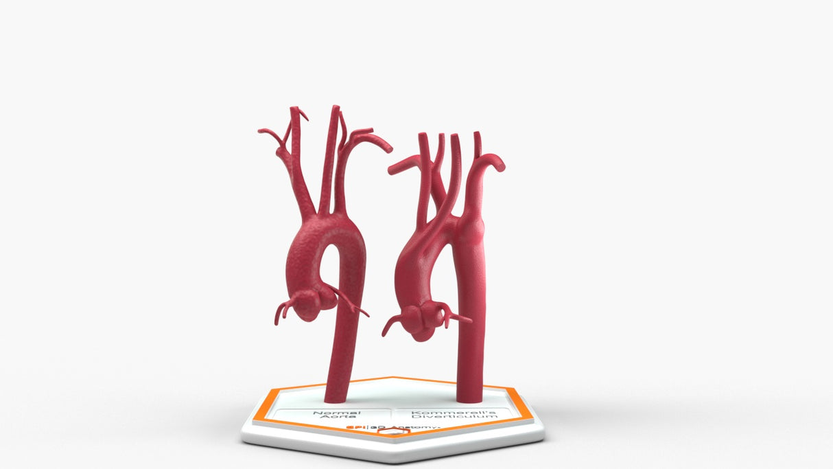 Normal & Kommerell's Diverticulum (Connected)