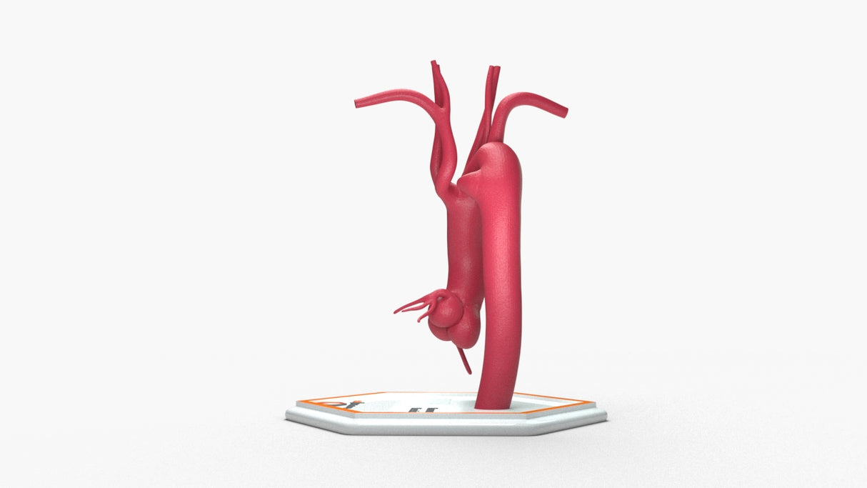 Kommerell's Diverticulum