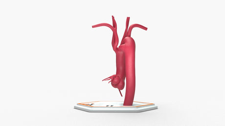Kommerell's Diverticulum