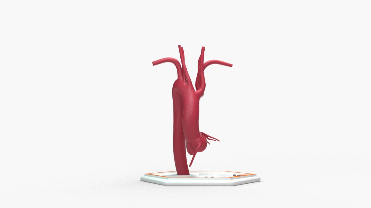 Kommerell's Diverticulum