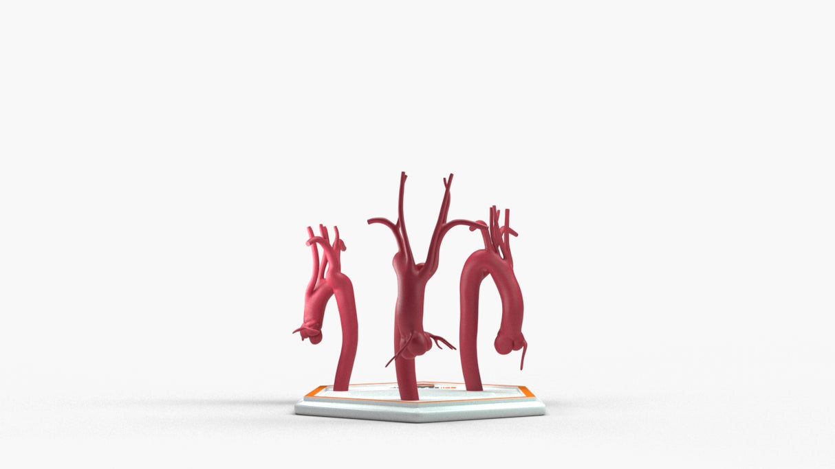 Kommerell's Diverticulum Series