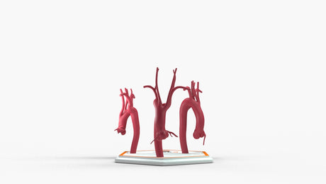 Kommerell's Diverticulum Series