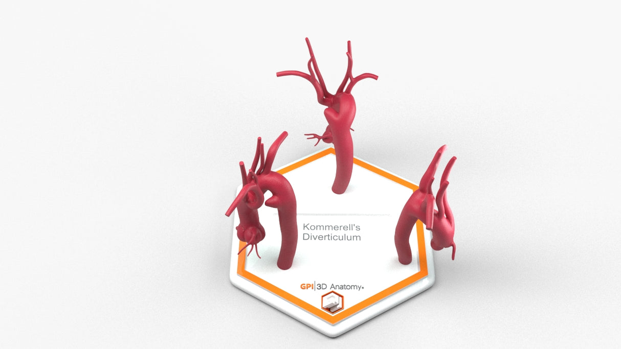 Kommerell's Diverticulum Series