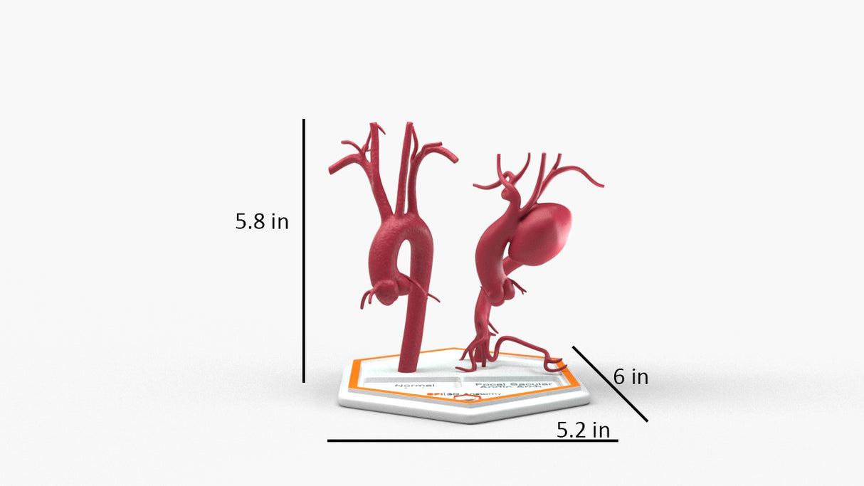 Aortic Arch - Normal and Focal Sacular Aneurysm