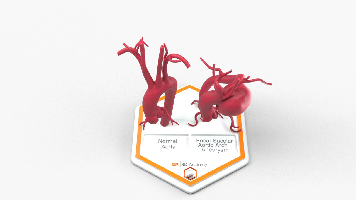 Aortic Arch - Normal and Focal Sacular Aneurysm