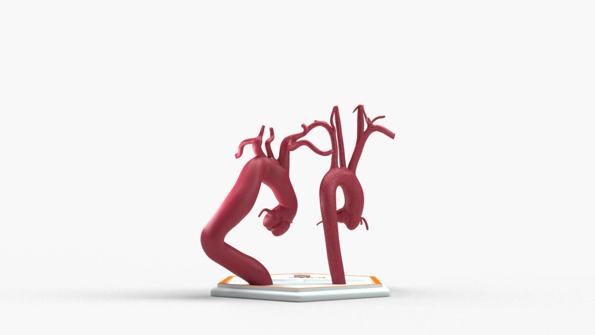 Aortic Arch - Normal and Fusiform with Proximal Descending Aneurysm