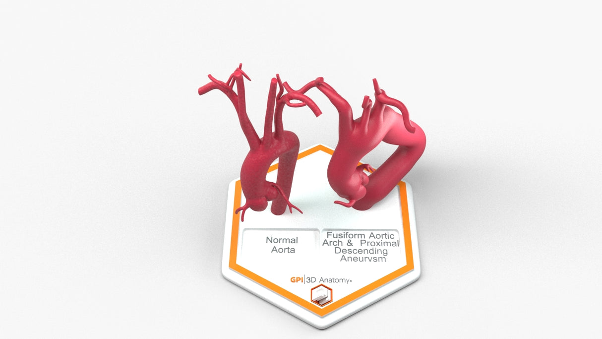 Aortic Arch - Normal and Fusiform with Proximal Descending Aneurysm