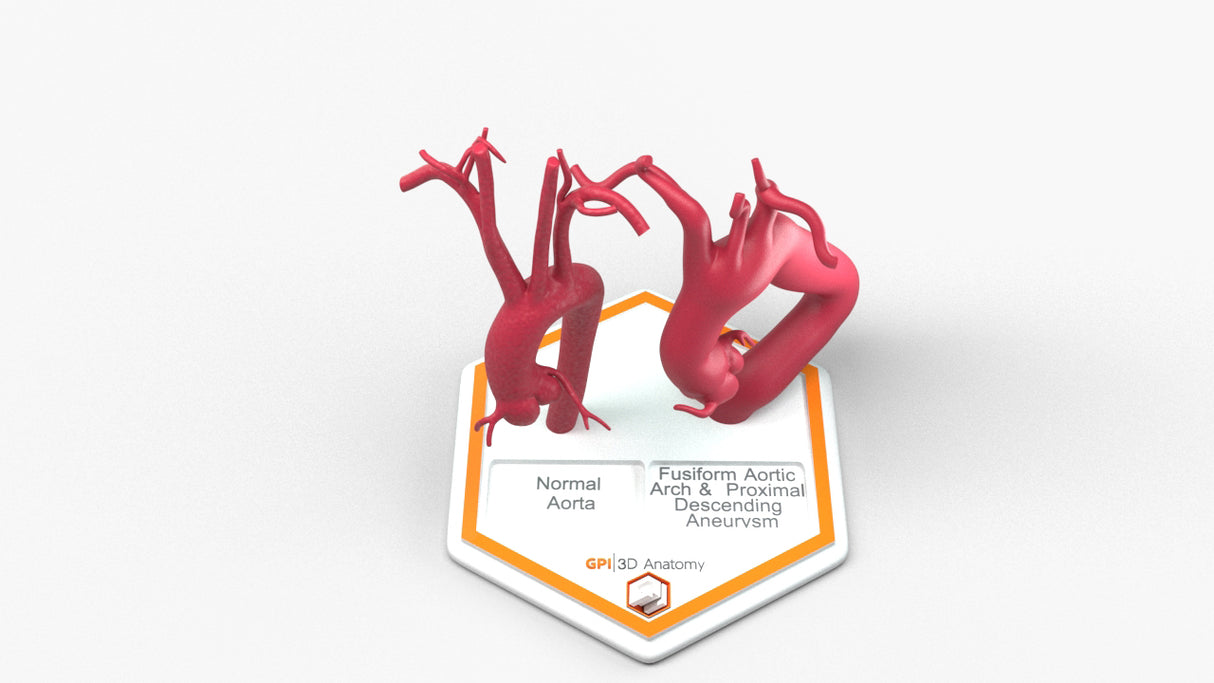 Aortic Arch - Normal and Fusiform with Proximal Descending Aneurysm