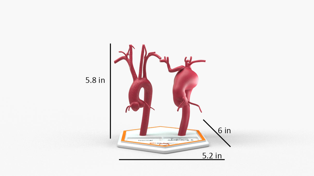 Aortic Arch - Normal and Fusiform Aneurysm