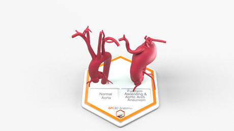 Aortic Arch - Normal and Fusiform Aneurysm