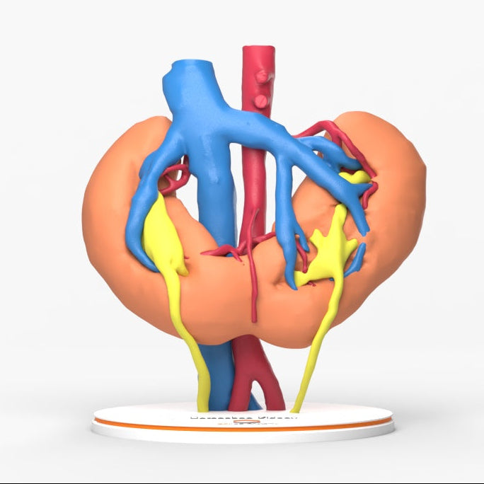 Horseshoe Kidney With Renal Cell Carcinoma (RCC) – Male, 41 Years