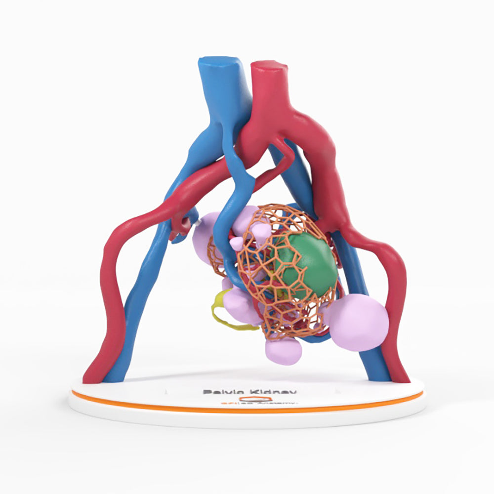 Lattice Pelvic Kidney With Neoplasm and Cysts - Male, 78 Years