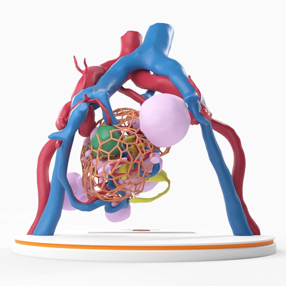 Lattice Pelvic Kidney With Neoplasm and Cysts - Male, 78 Years