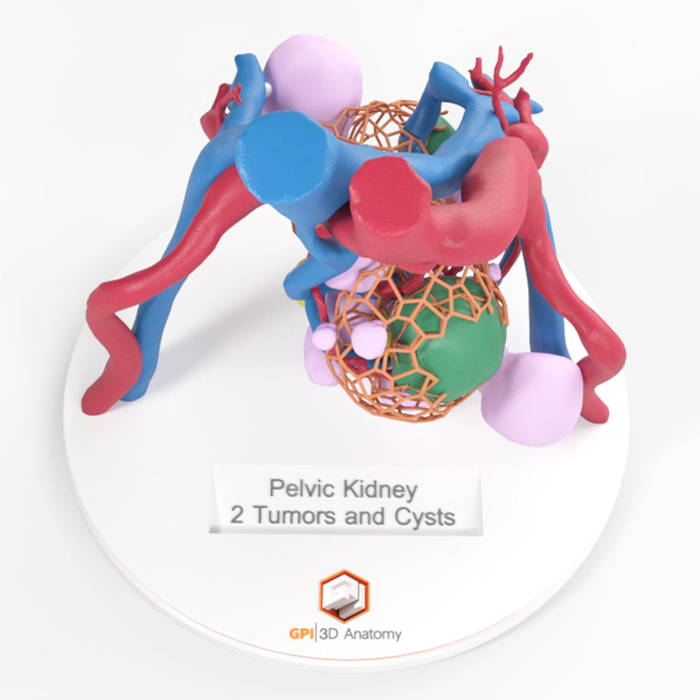 Lattice Pelvic Kidney With Neoplasm and Cysts - Male, 78 Years