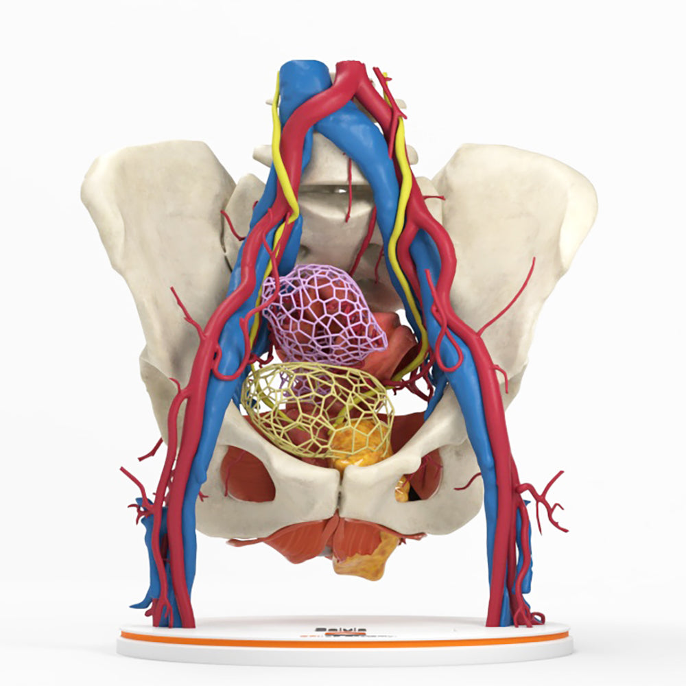 Pelvic Hernia – Female, 48 Years