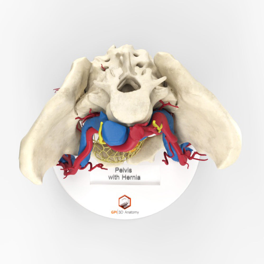 Pelvic Hernia – Female, 48 Years
