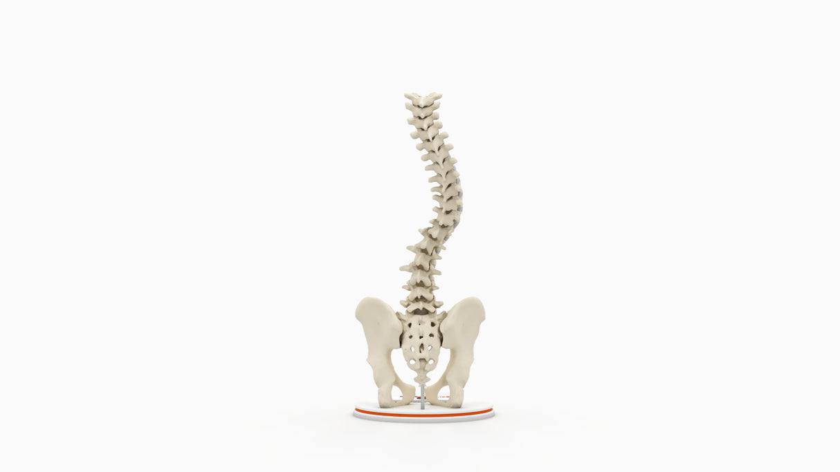 Scoliosis Type-1 Idiopathic 10