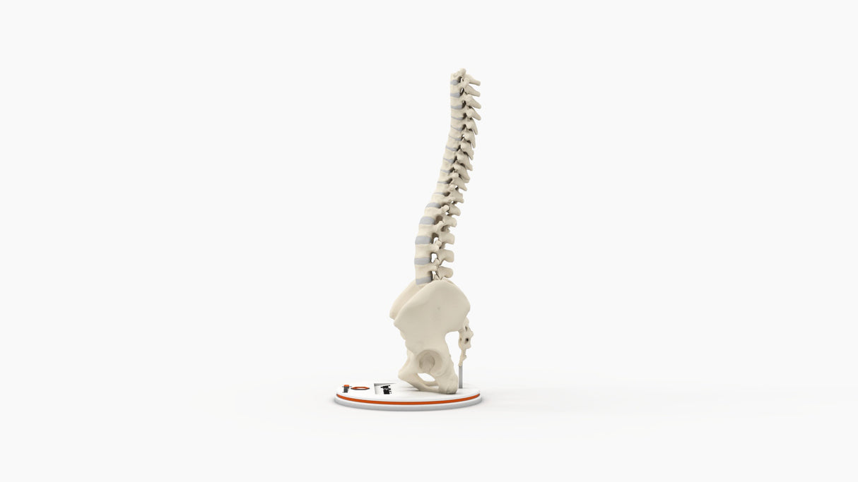 Scoliosis Type-1 Idiopathic 10