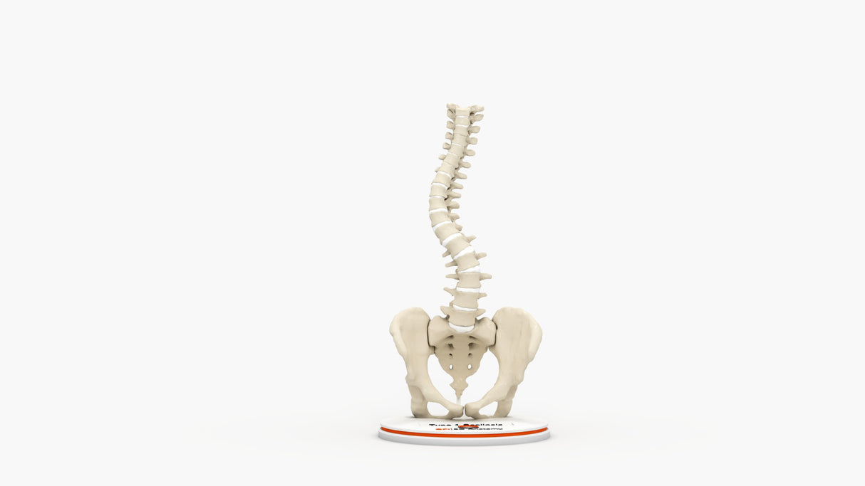 Scoliosis Type-1 Idiopathic 1