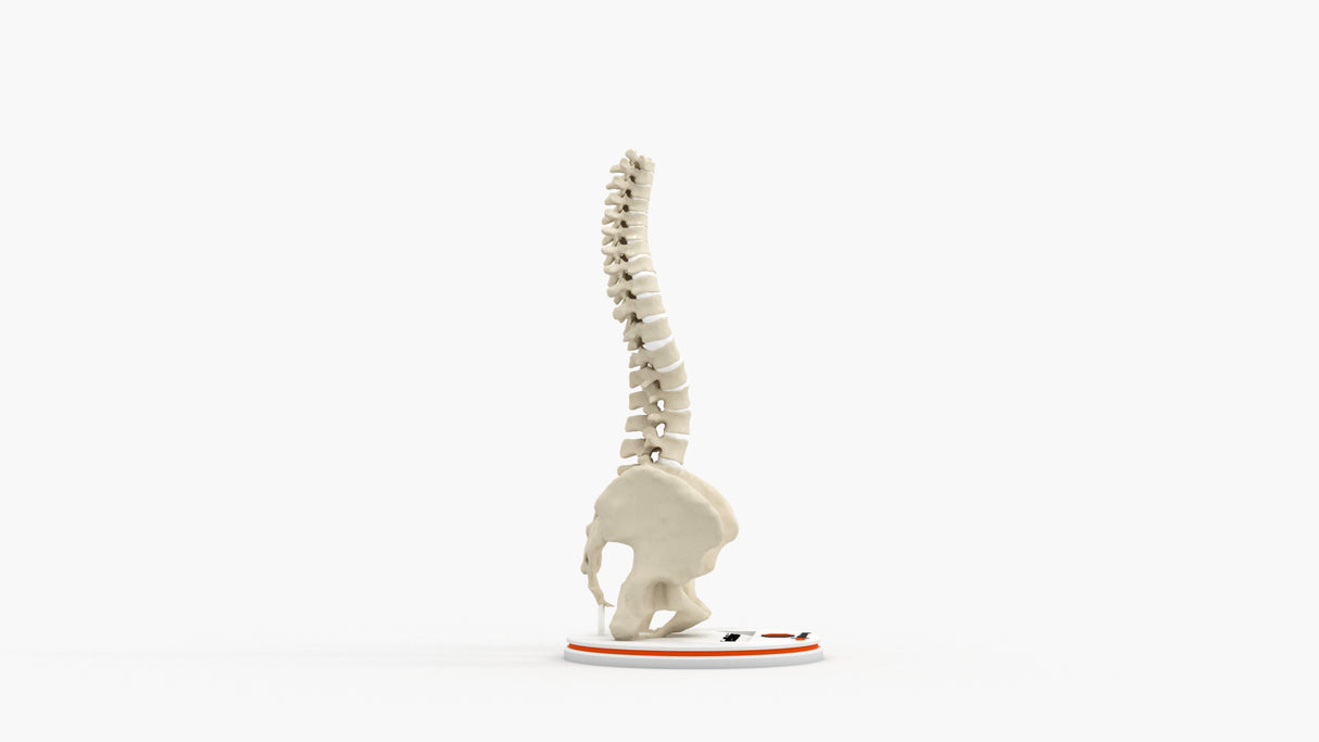 Scoliosis Type-1 Idiopathic 1