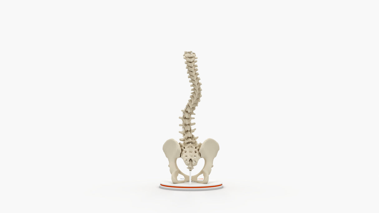 Scoliosis Type-1 Idiopathic 2
