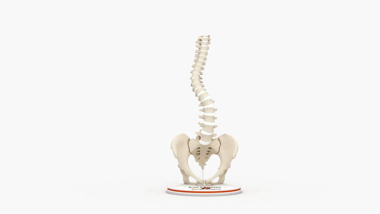 Scoliosis Type-1 Idiopathic 2