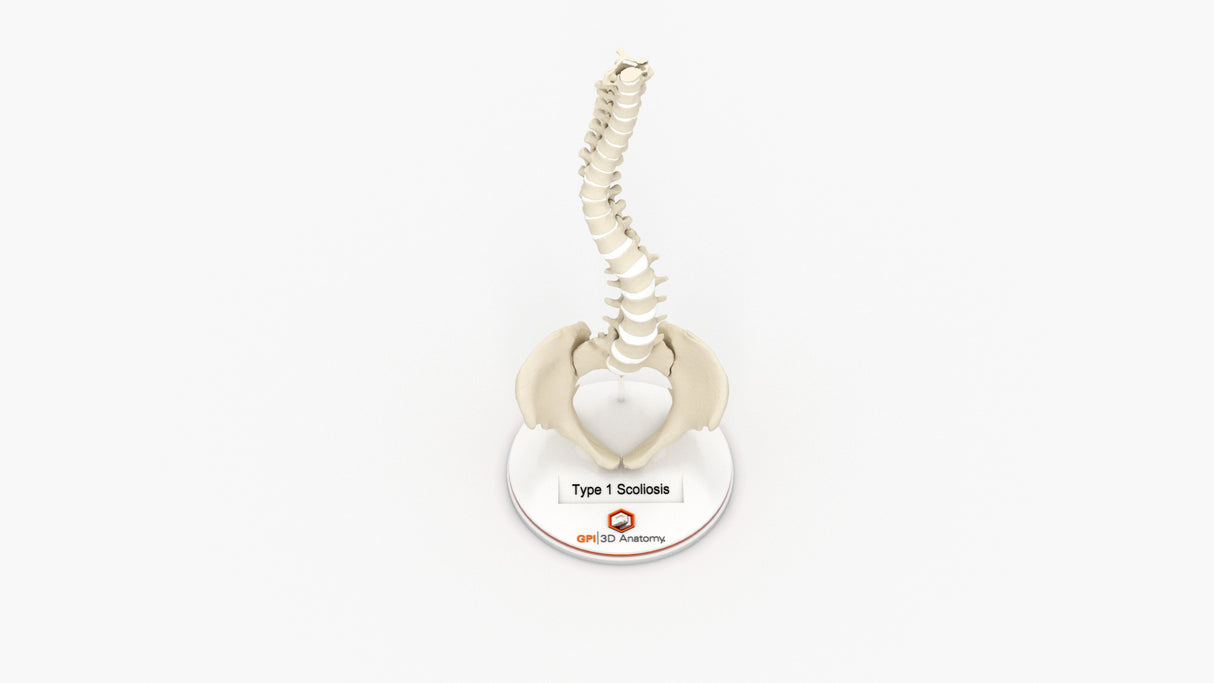 Scoliosis Type-1 Idiopathic 2