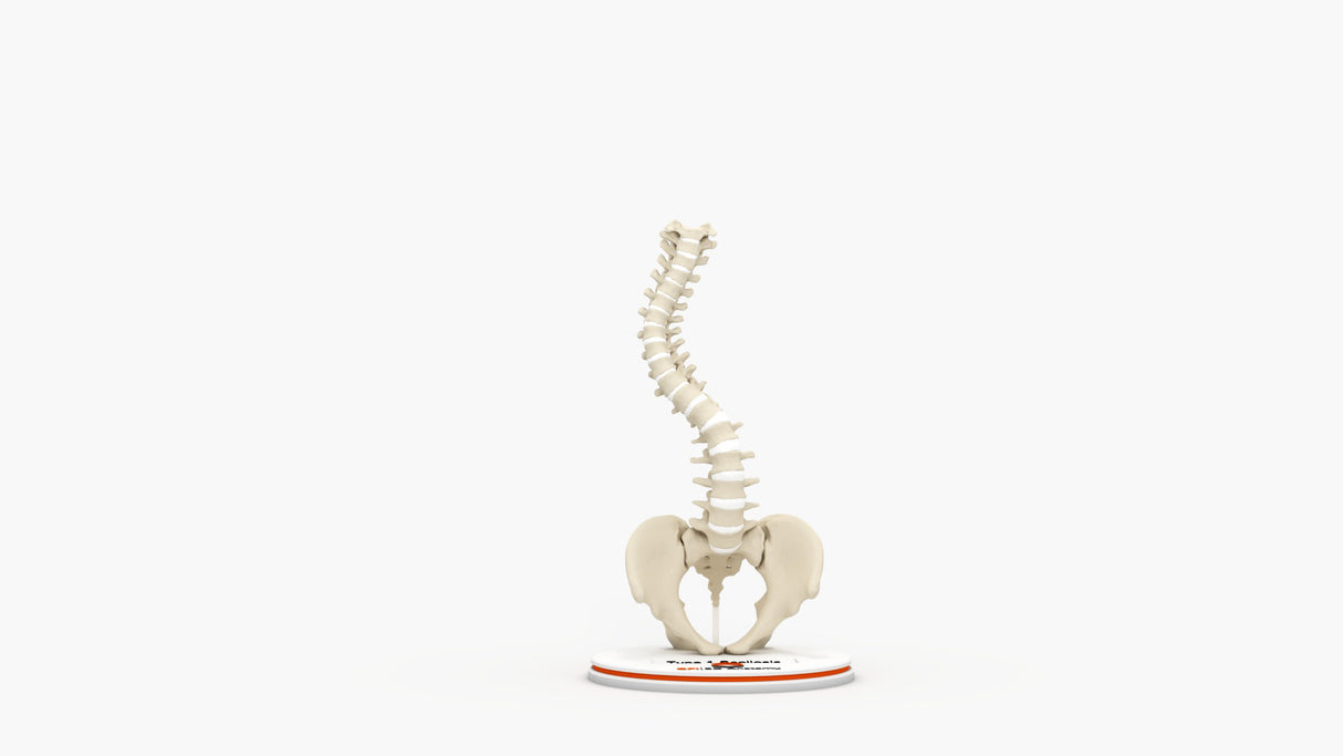 Scoliosis Type-1 Idiopathic 4
