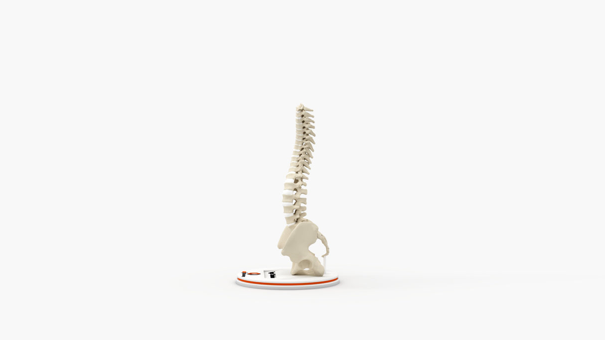 Scoliosis Type-1 Idiopathic 4