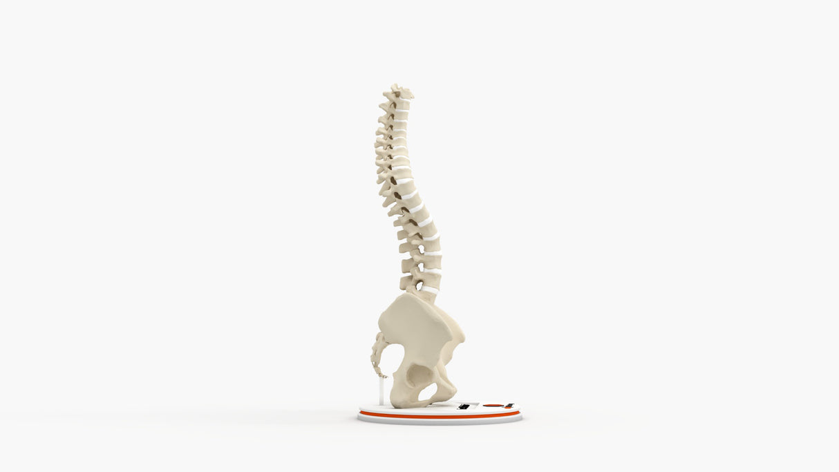 Scoliosis Type-1 Idiopathic 5