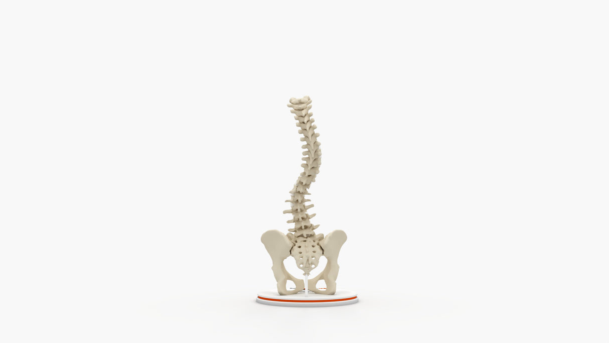 Scoliosis Type-1 Idiopathic 6
