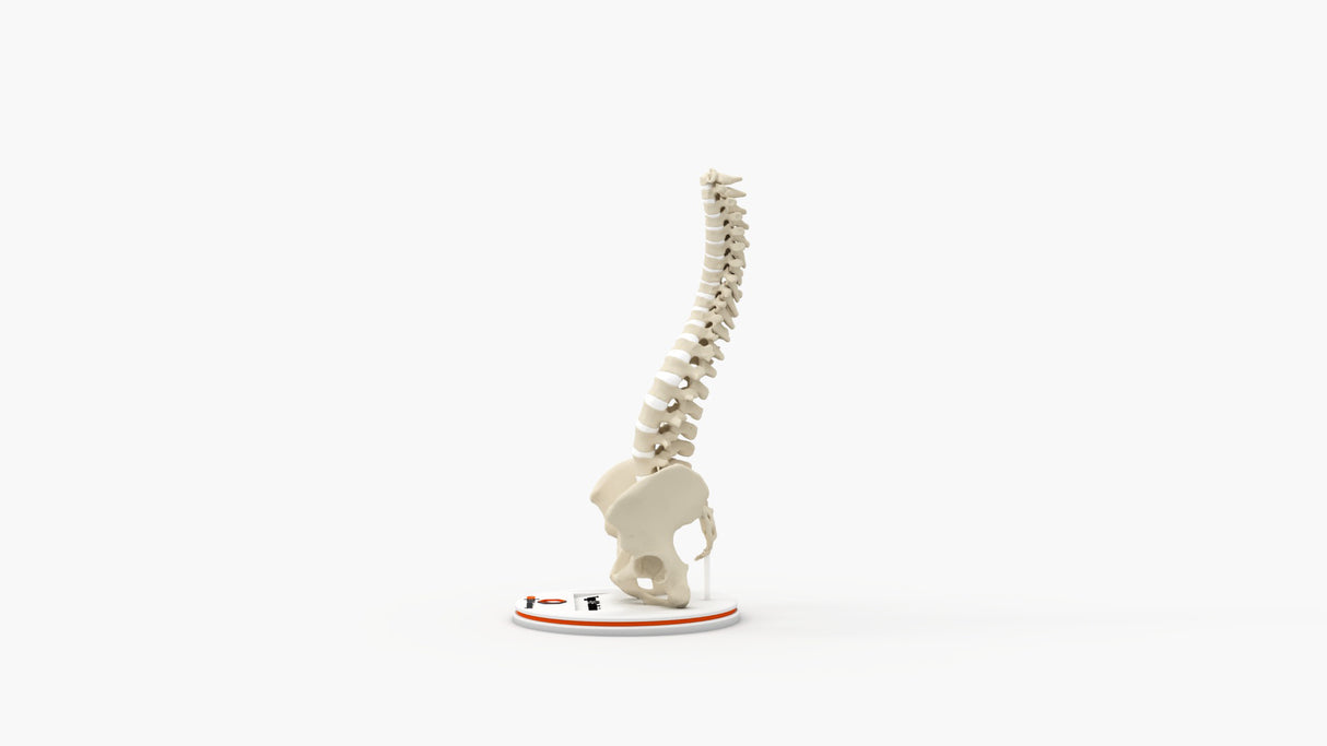 Scoliosis Type-1 Idiopathic 6