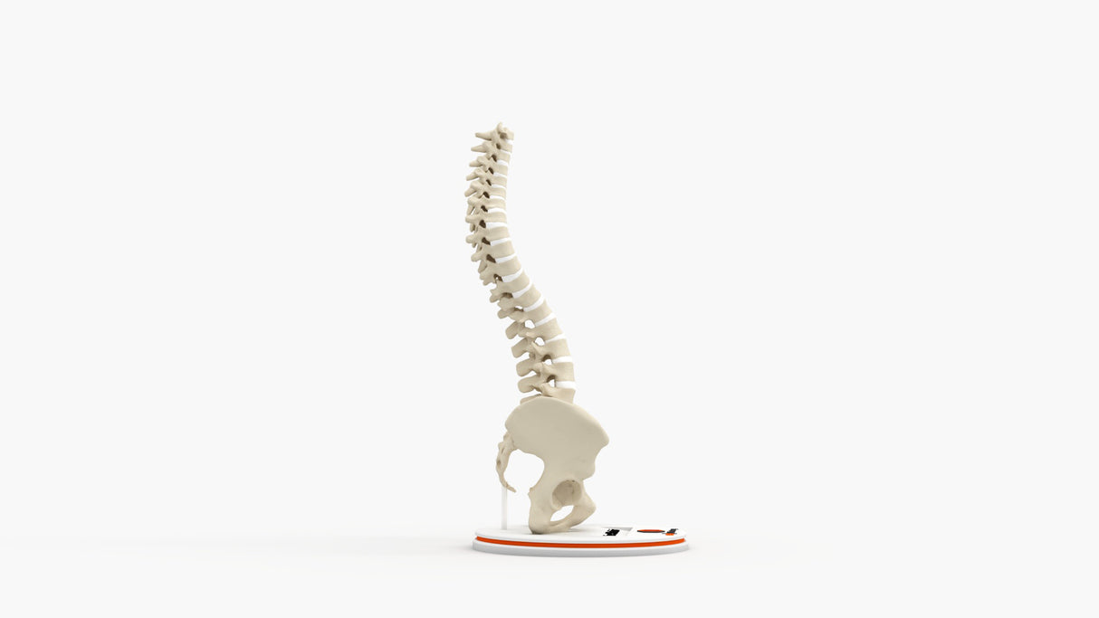Scoliosis Type-1 Idiopathic 6