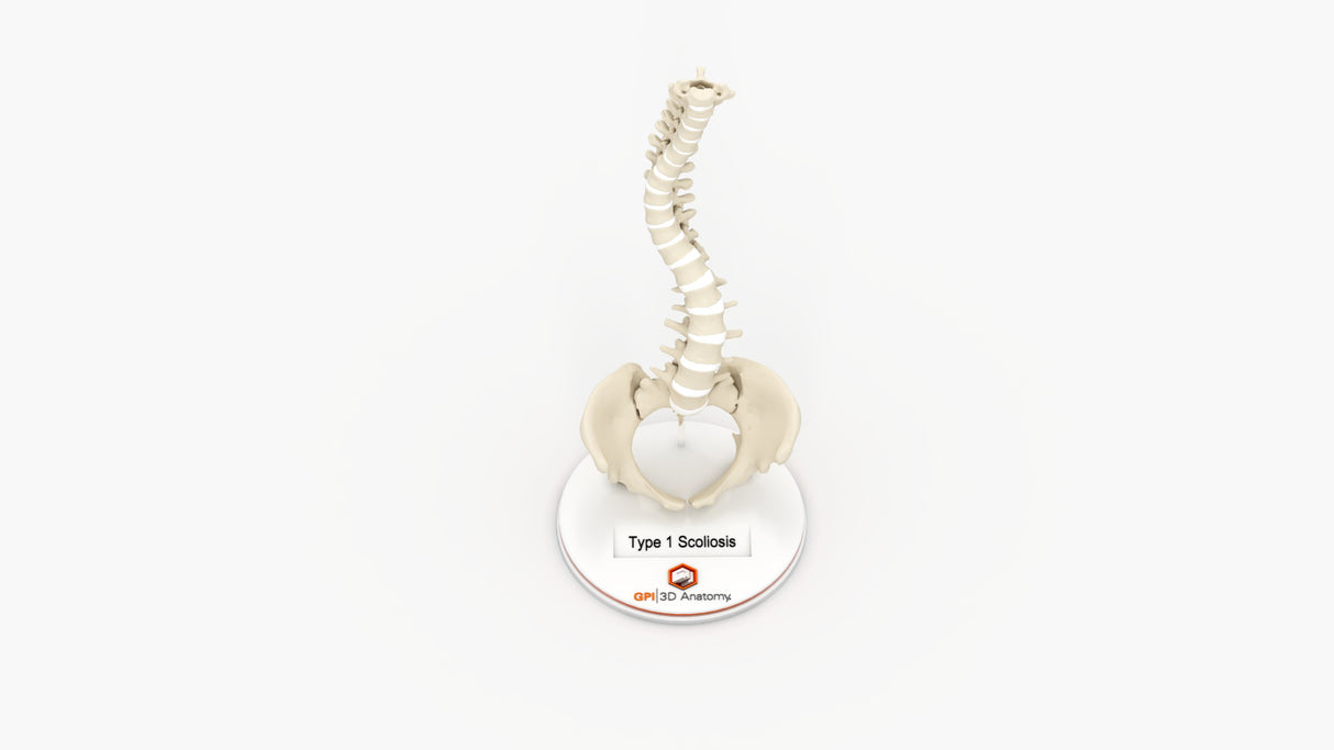 Scoliosis Type-1 Idiopathic 6