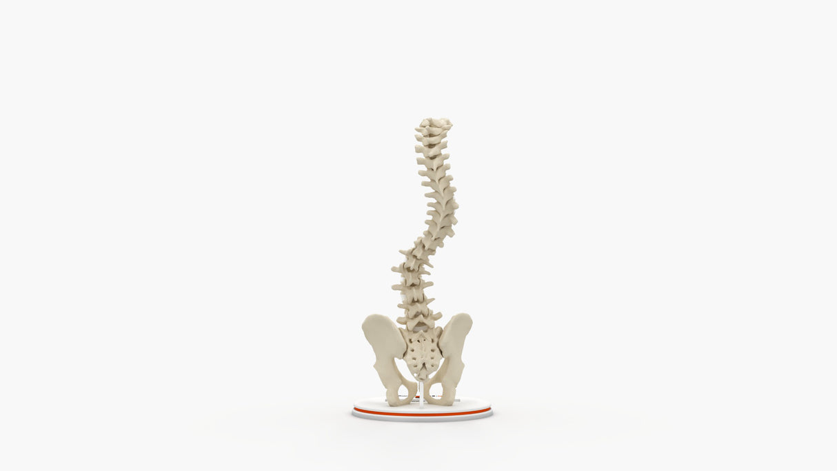 Scoliosis Type-1 Idiopathic 7