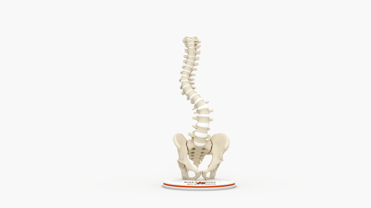 Scoliosis Type-1 Idiopathic 7