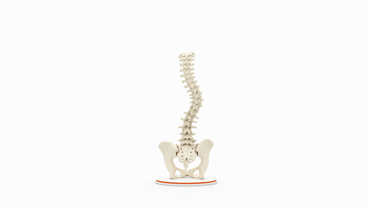 Scoliosis Type-1 Idiopathic 8