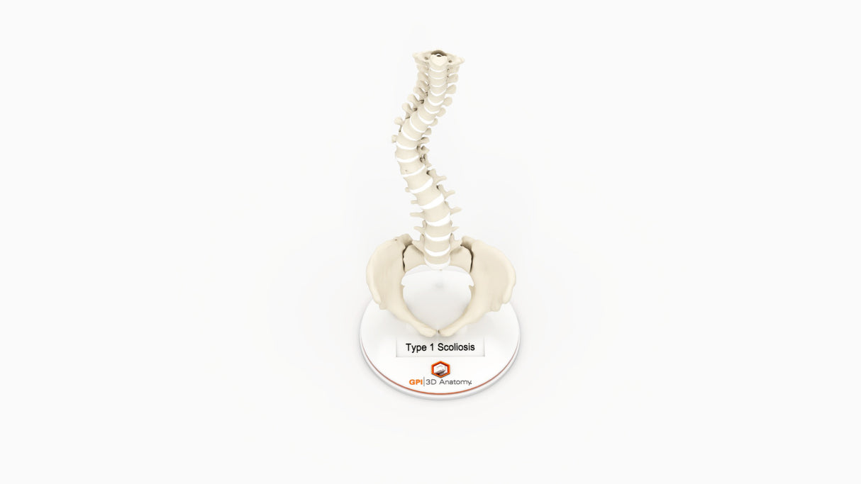 Scoliosis Type-1 Idiopathic 8