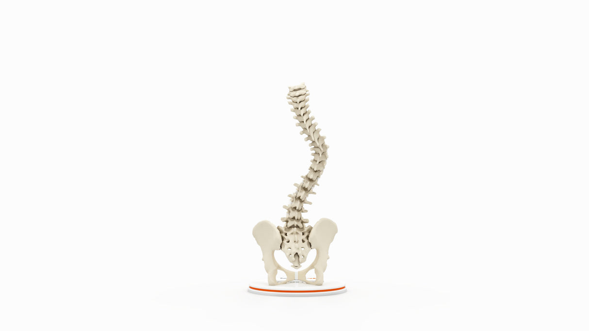 Scoliosis Type-1 Idiopathic 9