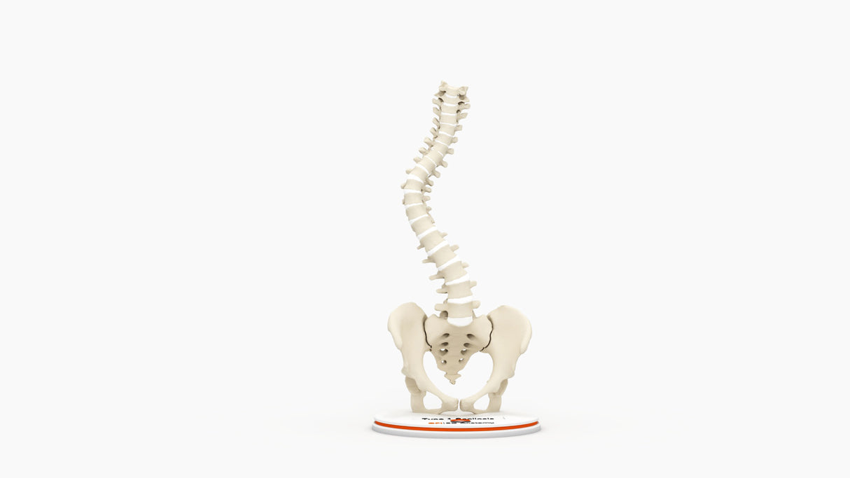 Scoliosis Type-1 Idiopathic 9