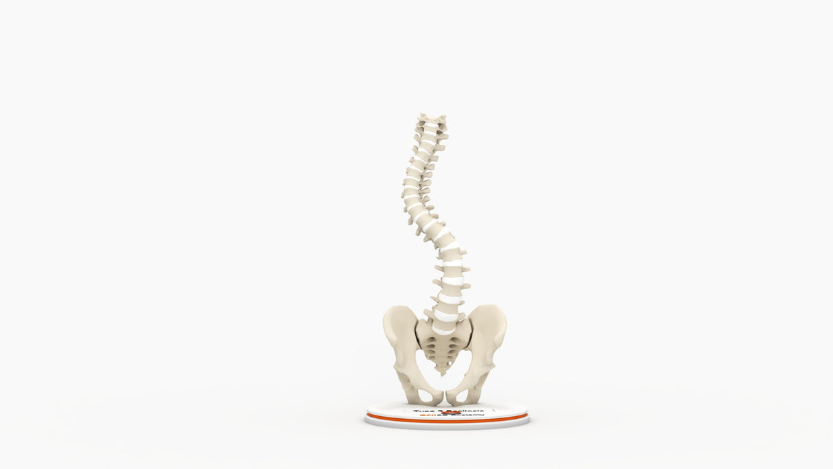 Scoliosis Type-2 Model 1