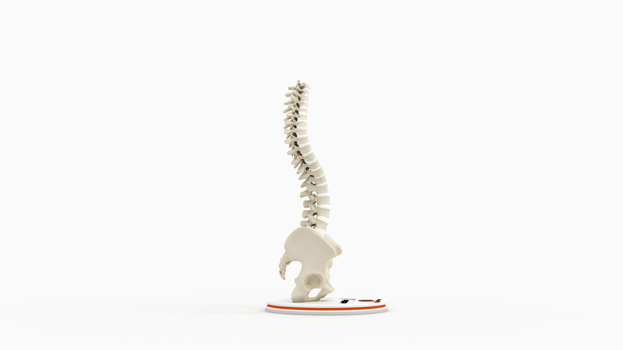 Scoliosis Type-2 Model 1