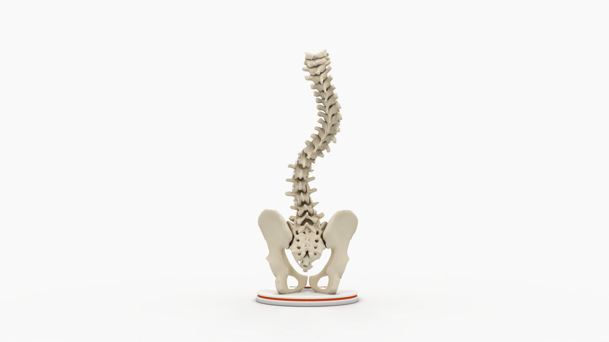 Scoliosis Type-2 Model 2